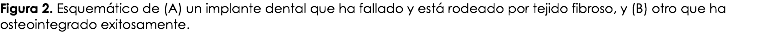 Figura 2. Esquemático de (A) un implante dental que ha fallado y está rodeado por tejido fibroso, y (B) otro que ha osteointegrado exitosamente.